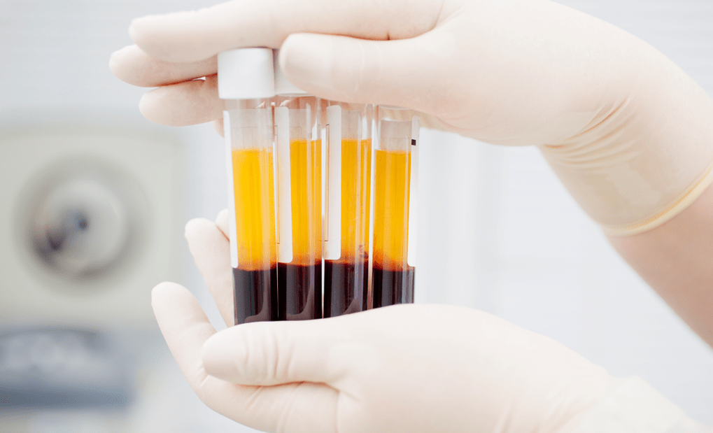 Plasma ricco di piastrine per la terapia PRP per l'artrosi